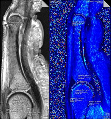 Evaluation of finger cartilage composition in recreational climbers with 7 Tesla T2 mapping magnetic resonance imaging